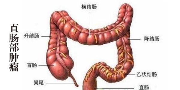 预约人数:90 常见病,易复发,中医 直肠癌是指位于齿状线至乙状结肠